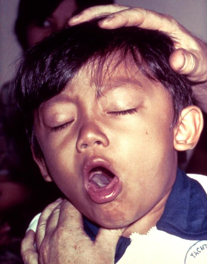 Photo: Boy with pertussis