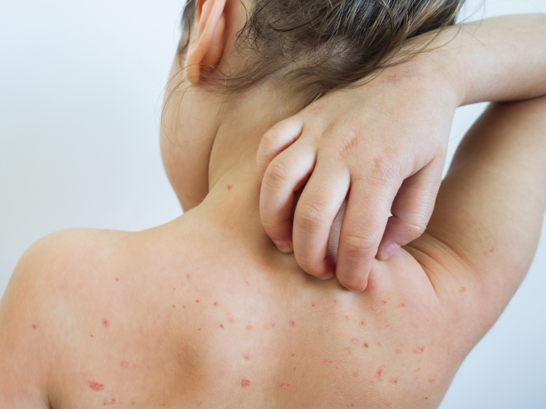 measles-outbreaks