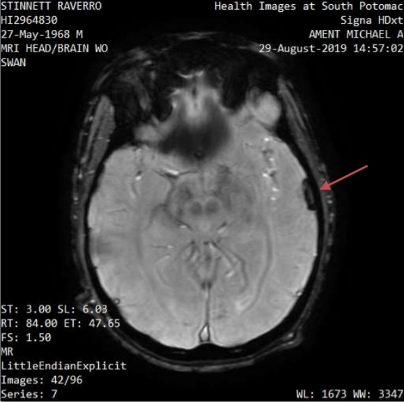 Raverro Stinnett brain scan MRI