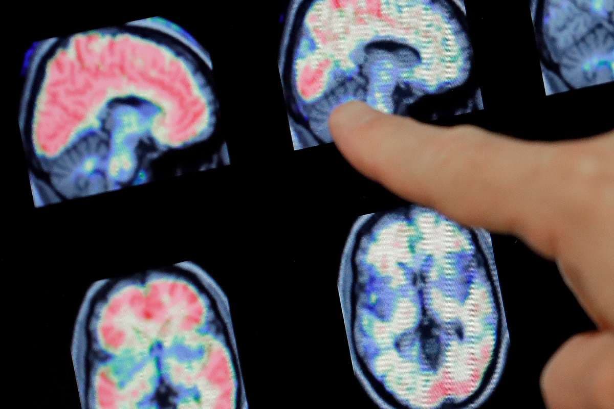 a hand pointing to brain scan