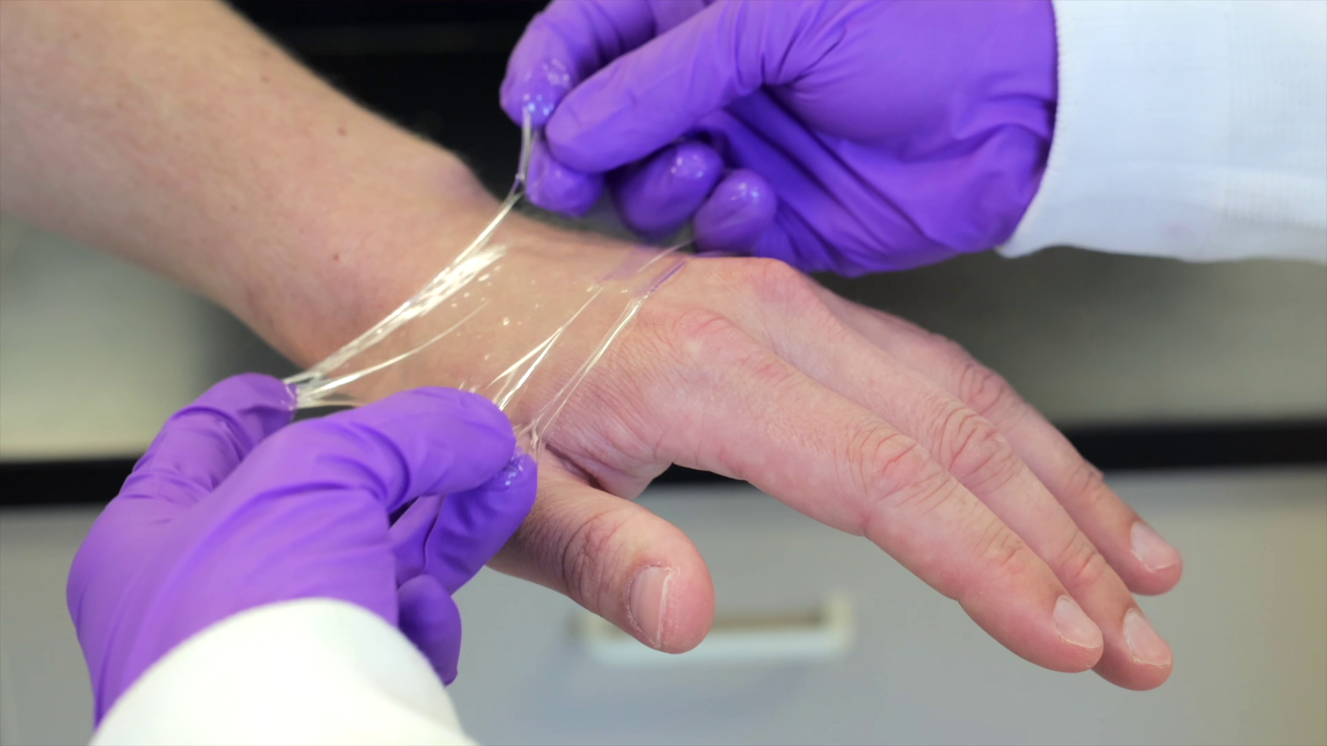 New polymer material being applied to patient